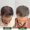 ALIKA HAIR RESTORATION SYSTEM 14