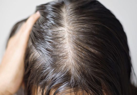 Preventing Hair Loss Due to Nutritional Deficiencies: A Guide to Nourishing Your Hair 6