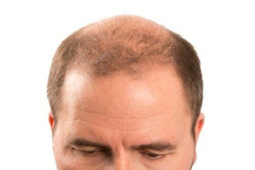 7 Stages of Male Pattern Baldness You Should Know 10