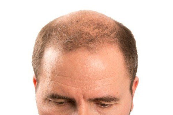 7 Stages of Male Pattern Baldness You Should Know 14