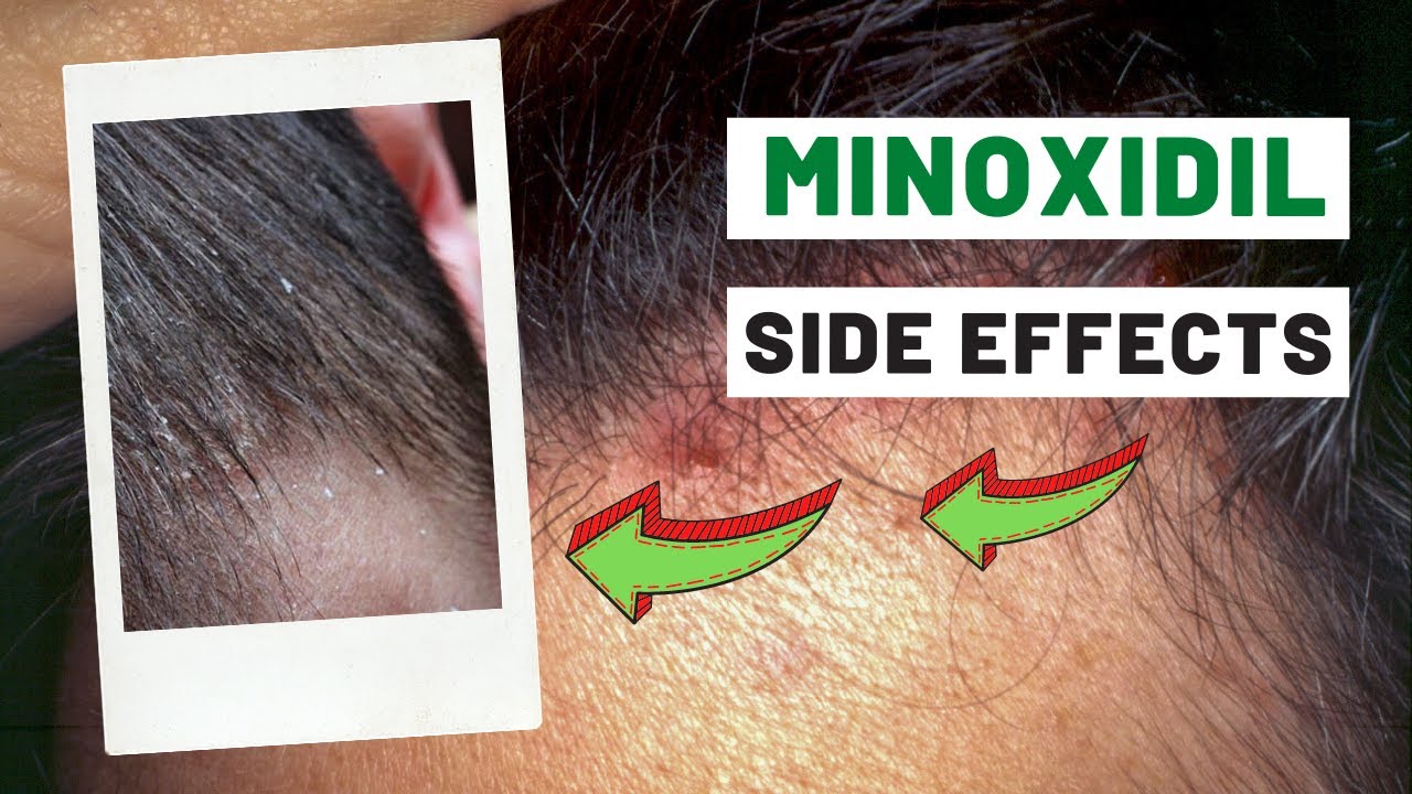 minoxidil side effects